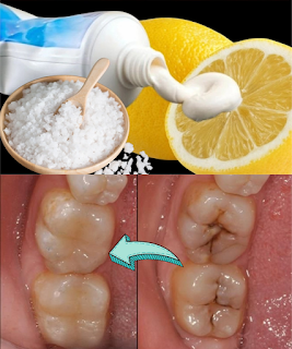 🦷 Can You Naturally Support Early Tooth Decay? Here’s What You Should Know